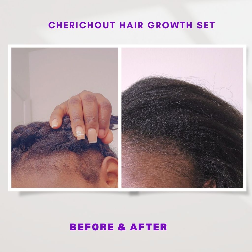 Kit para el crecimiento del cabello (Mejorado)